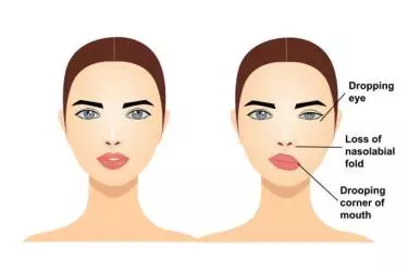 best hospital for facial palsy treatment in madhepura, best doctor for facial palsy treatment in madhepura, cost of facial palsy treatment in madhepura